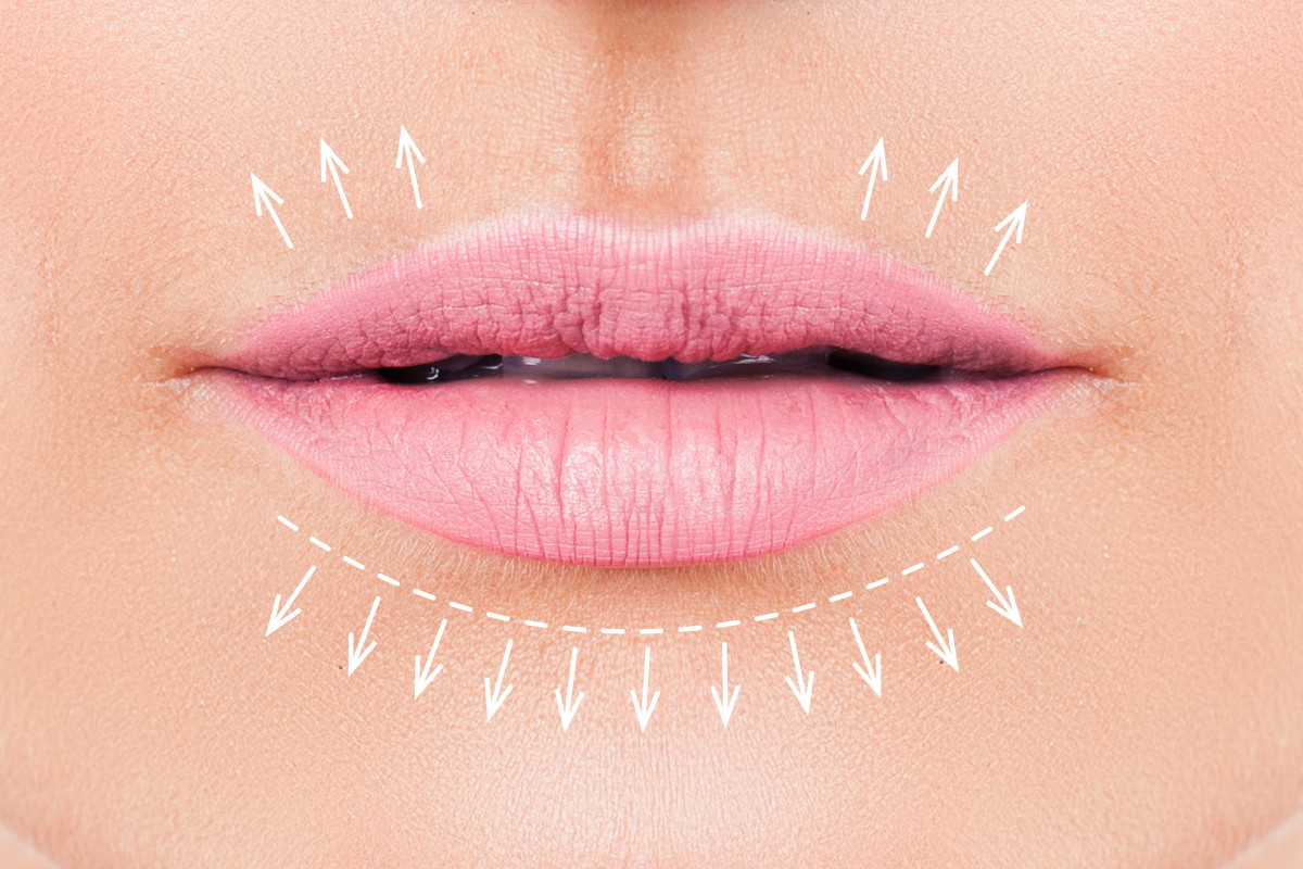 Quanto Tempo Dura O Preenchimento Labial E Como Feito Clinica Lissome