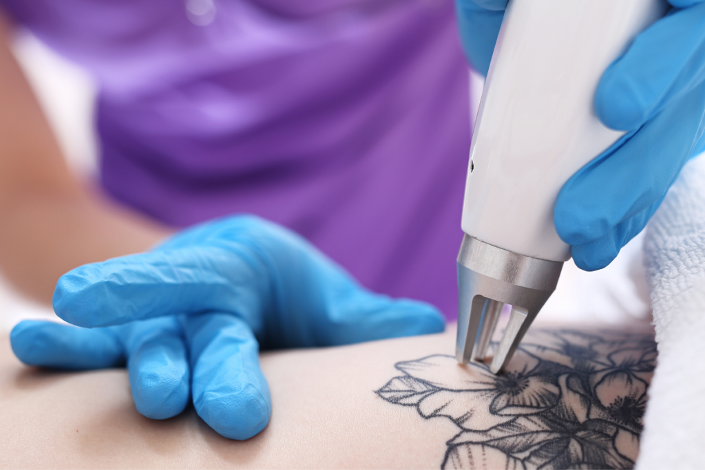 A remoção de tatuagem deve ser feita com processos seguros.