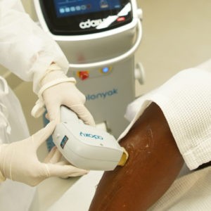 A depilação a laser em pele negra exige uma série de cuidados.